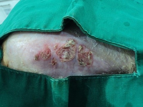 비만세포종양(Mast Cell Tumor) - MCT 